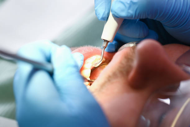 Best Emergency Wisdom Tooth Extraction in Elk Creek, KY